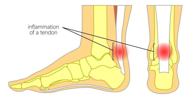 Achilles Tendonitis Treatment 