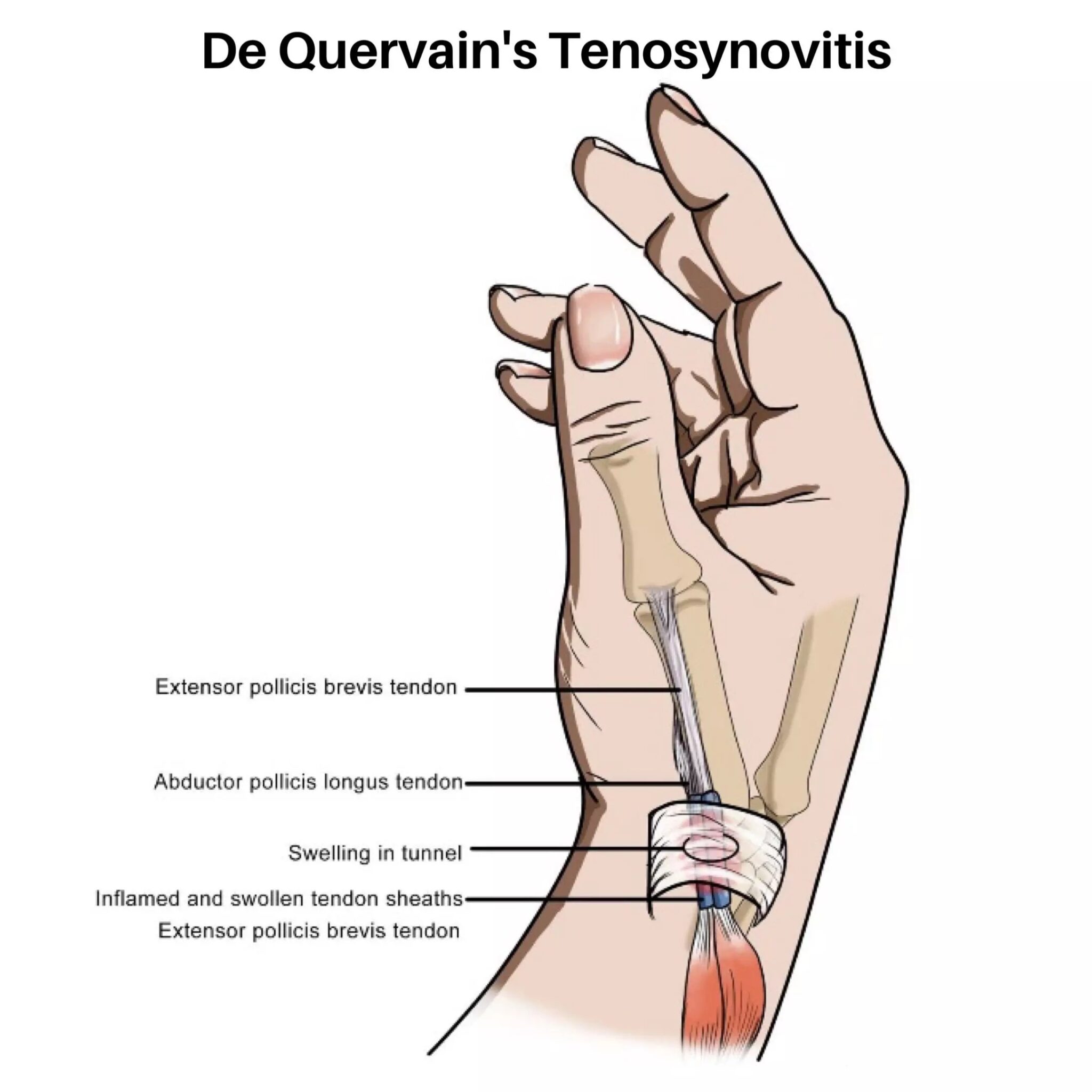 De Quervain s Tenosynovitis Sports Injury Treatment