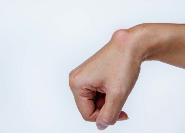 Ganglion Right Hand Cyst