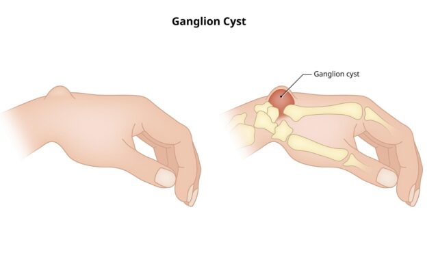 Ganglions Anatomy