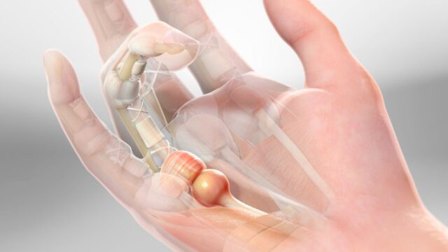 Trigger Finger Anatomy