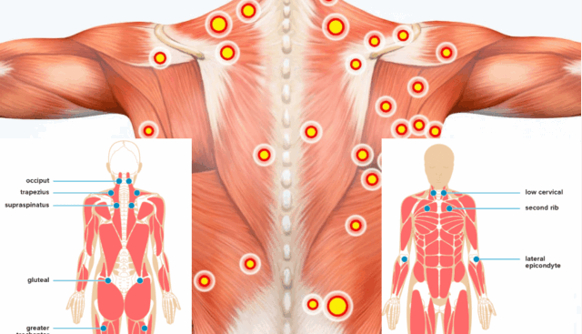 Trigger Points