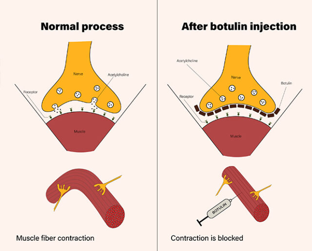 Botox Muscle Anatomy